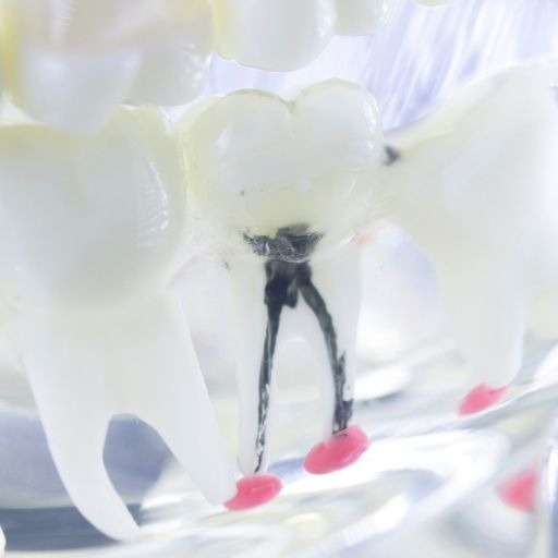Root Canal Therapy
