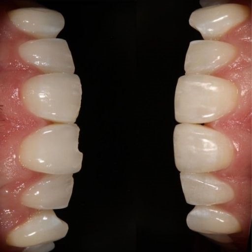 Tooth Bonding for Minor Chips and Stains