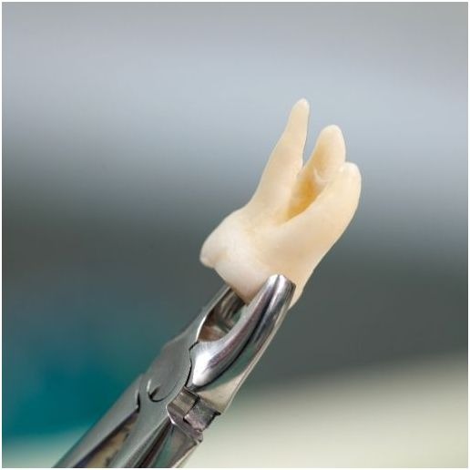 What to do if your tooth is knocked out