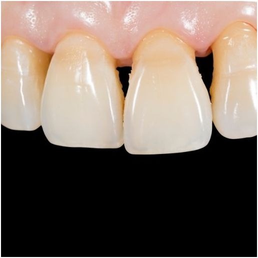 Fighting gum disease early