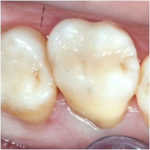 Fillings Seal Gaps