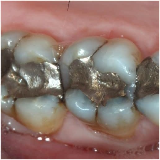 White Fillings Composite Fillings Local East Victoria Park Dentists