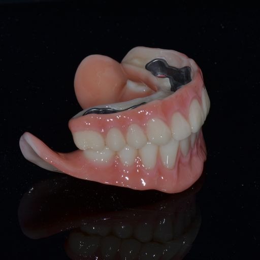 Implant-retained dentures