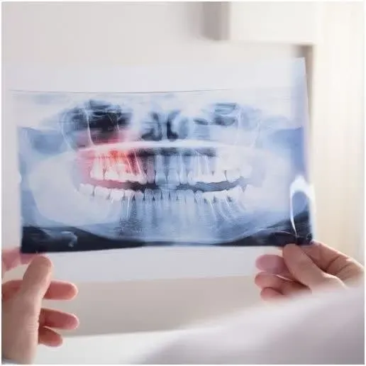 Wisdom Teeth Removal Perth