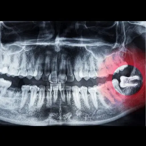 Reasons to remove wisdom teeth