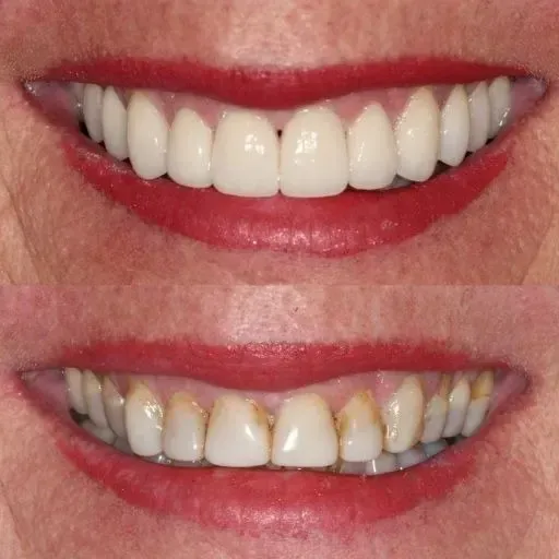 Veneers