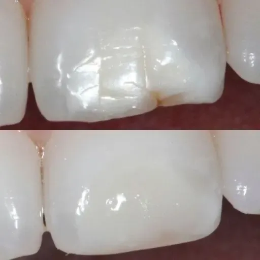 How Tooth Bonding Works