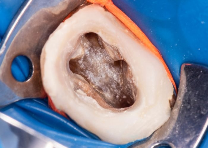 Root Canal Treatment Risks