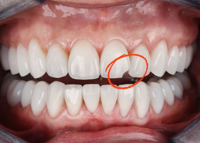 Composite Bonding treatment risks