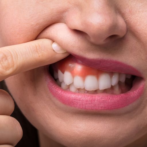 Teeth whitening risks