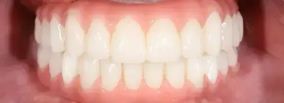 All-On-4® Dental Implants