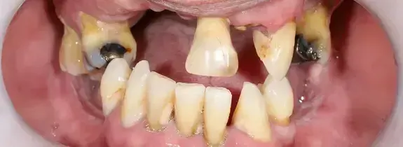 All-On-4® Dental Implants