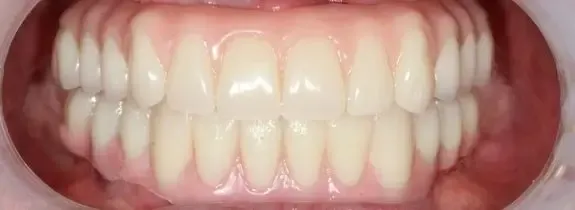 All-On-4® Dental Implants