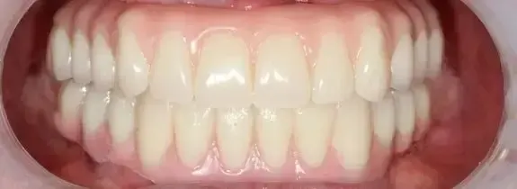 All-On-4® Dental Implants