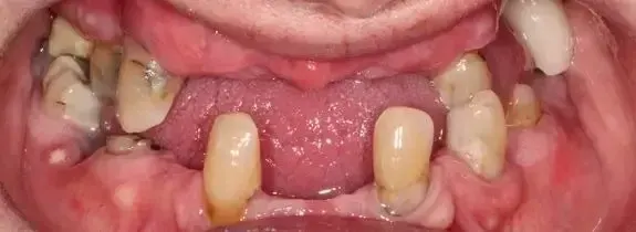 All-On-4® Dental Implants