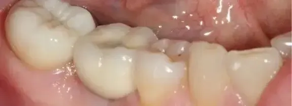 Single Dental Implant