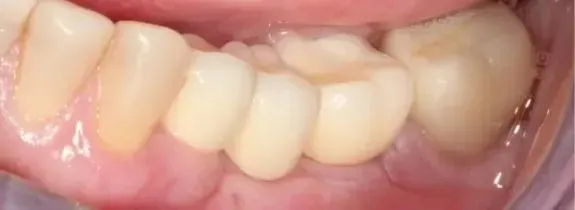 Fixed Implant Bridge