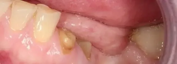 Fixed Implant Bridge