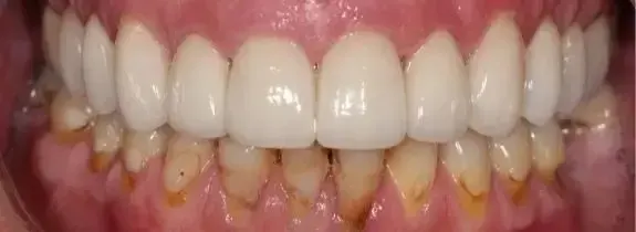 Upper Porcelain Veneers
