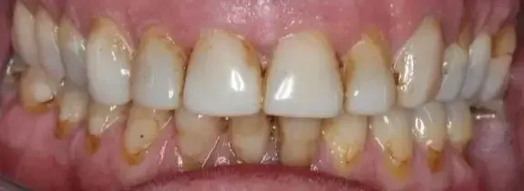 Upper Porcelain Veneers