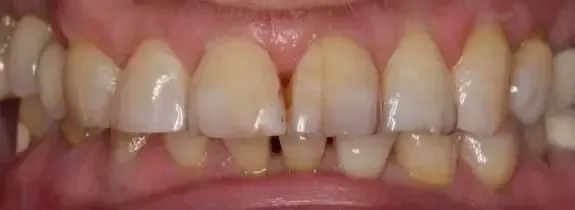 Composite Veneers