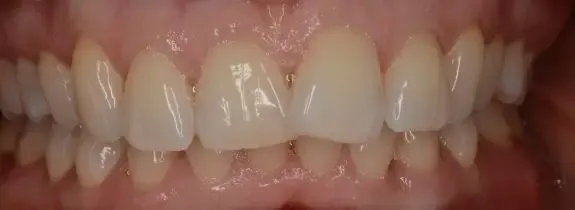 Invisalign® Treatment by Dr Liong Ting BDSc (UWA)