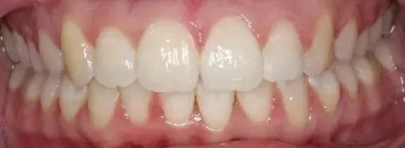 Teeth Straightening and Teeth Whitening
