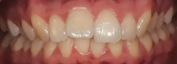Teeth Straightening and Teeth Whitening