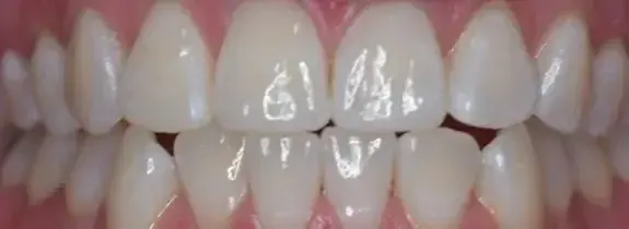 Teeth Whitening