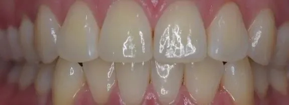 Teeth Whitening